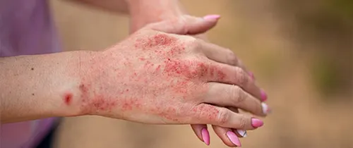 چگونه التهاب پوست را با گیاهان دارویی کنترل کنیم؟