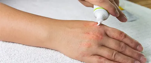 چگونه التهاب پوست را با گیاهان دارویی کنترل کنیم؟