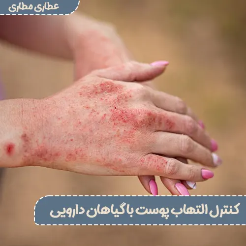 چگونه التهاب پوست را با گیاهان دارویی کنترل کنیم؟