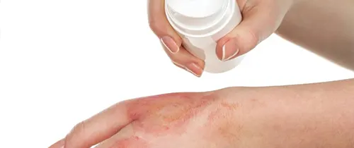 چگونه التهاب پوست را با گیاهان دارویی کنترل کنیم؟