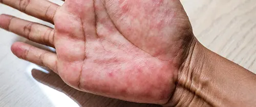 چگونه التهاب پوست را با گیاهان دارویی کنترل کنیم؟